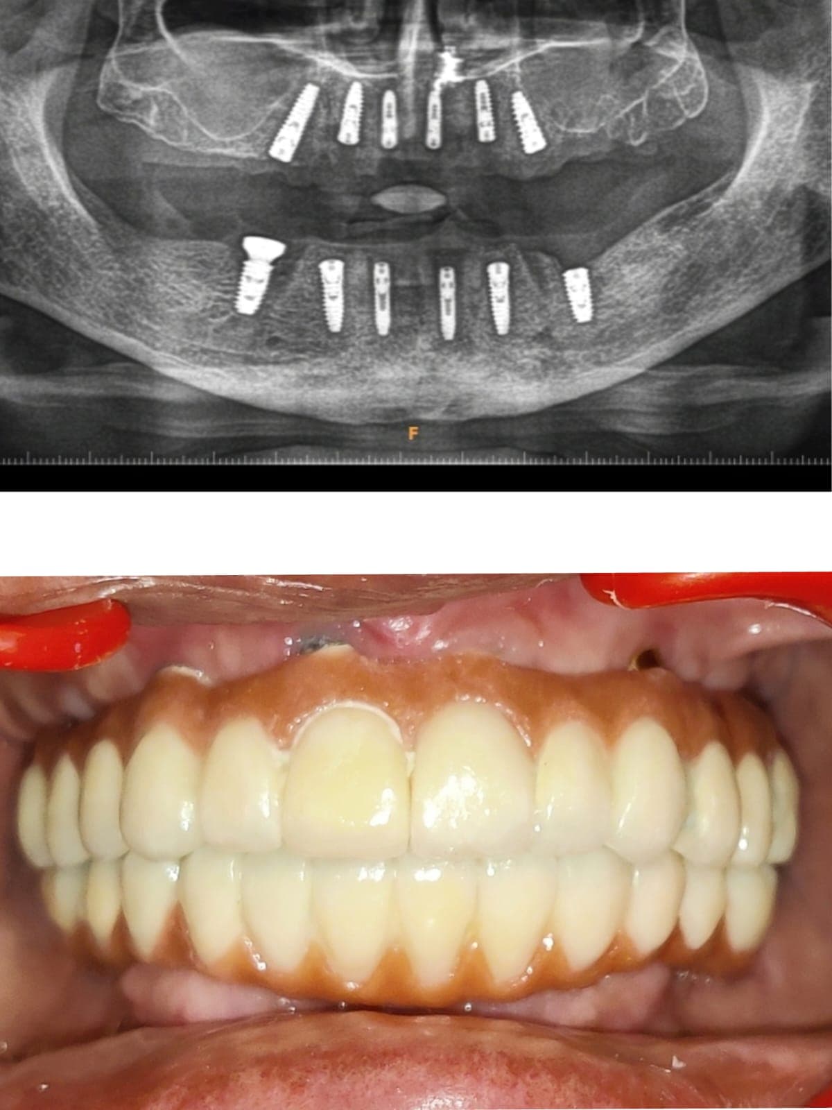Implant Case #7