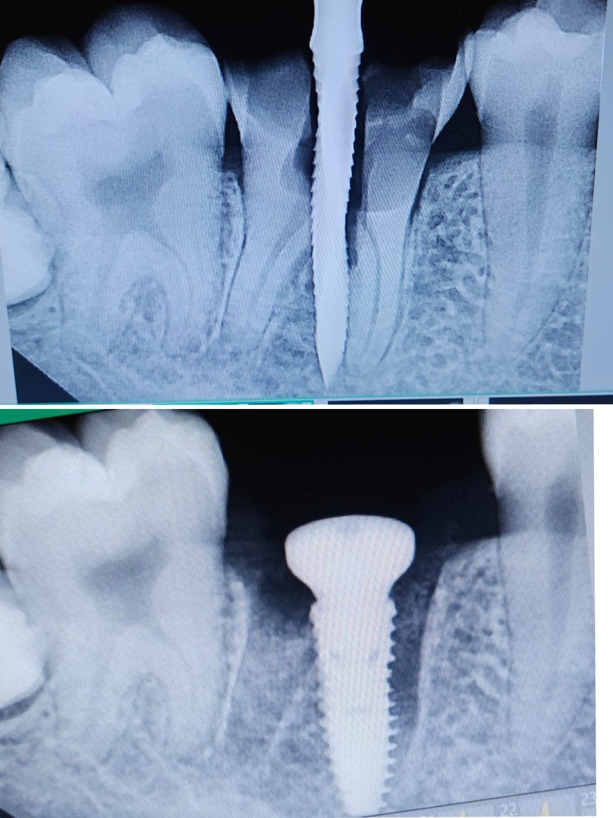 Implant Case #11