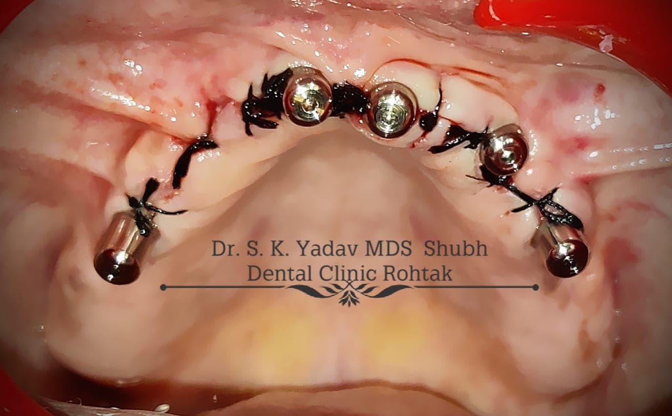 Implant Case #14