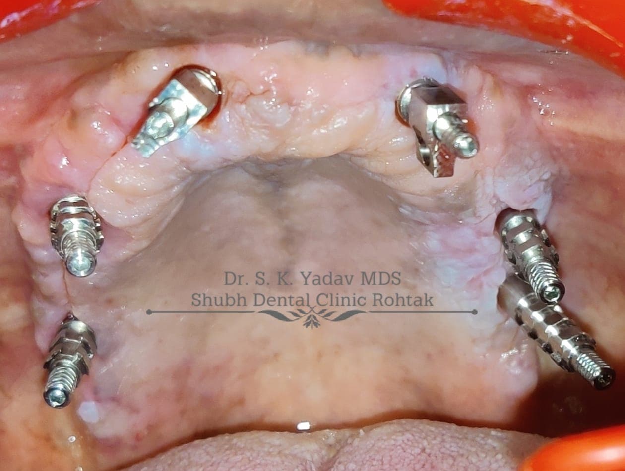 Implant Case #17