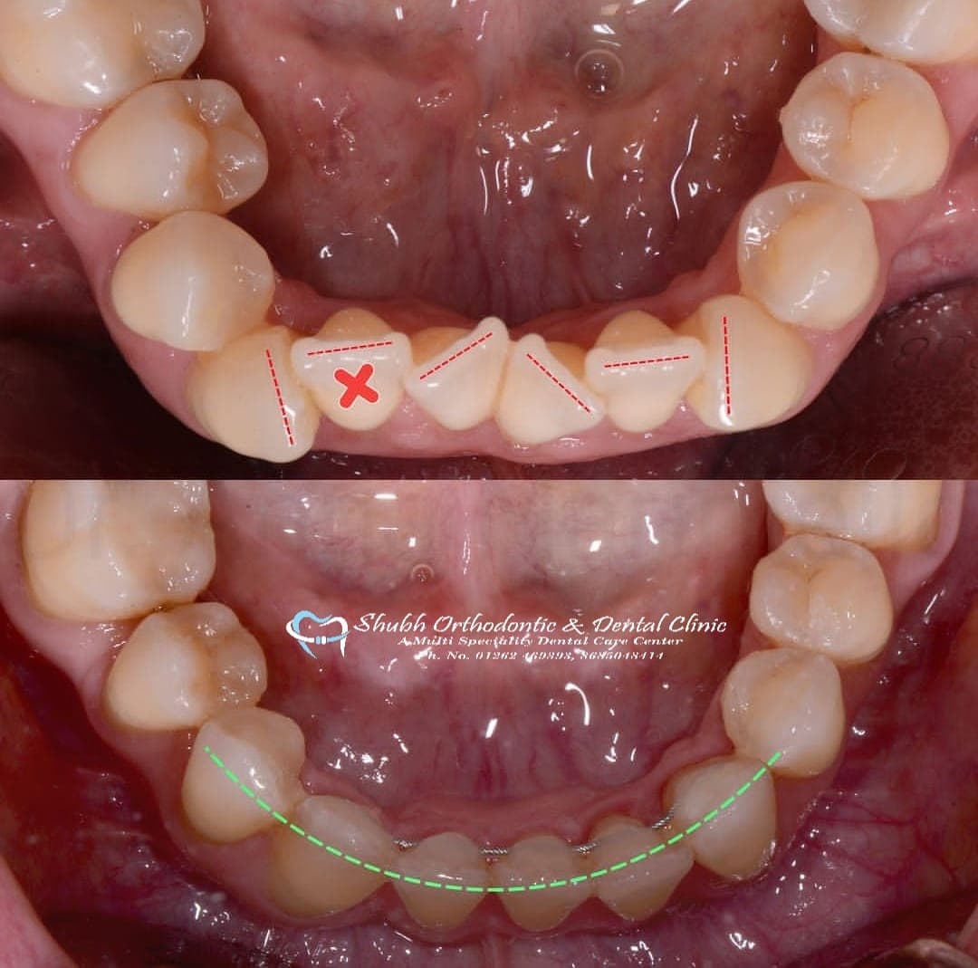 Orthodontic Case #2
