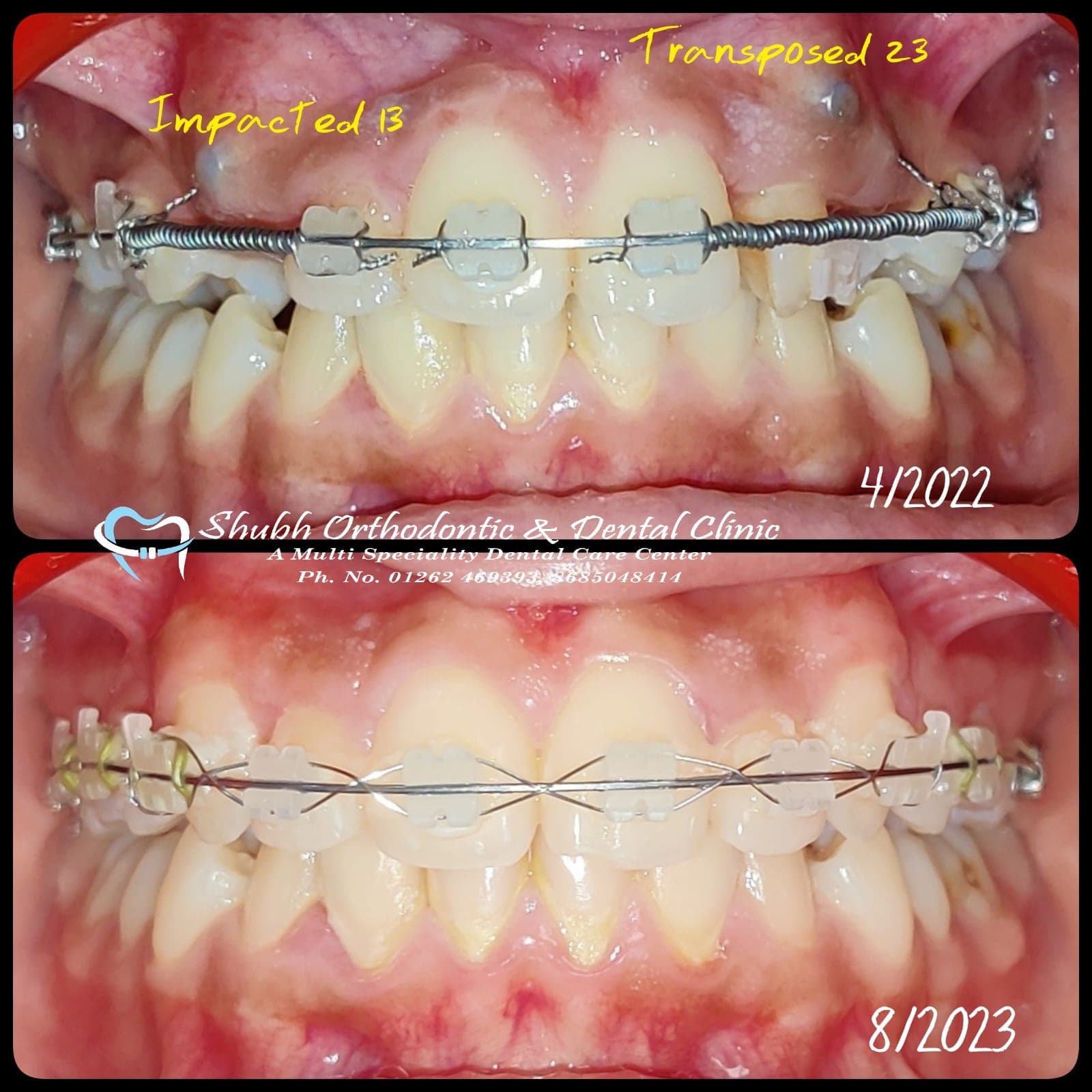 Orthodontic Case #3