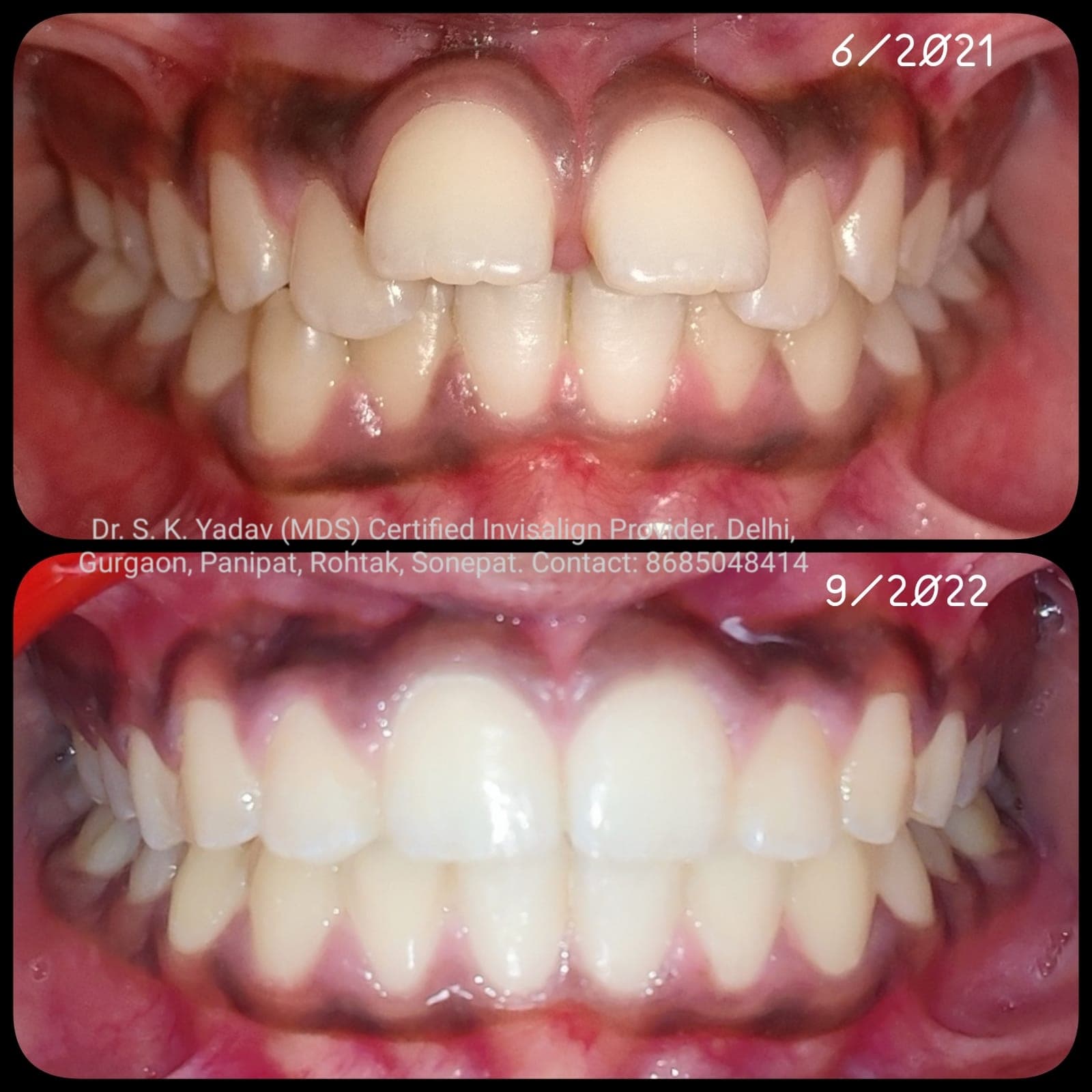 Orthodontic Case #7