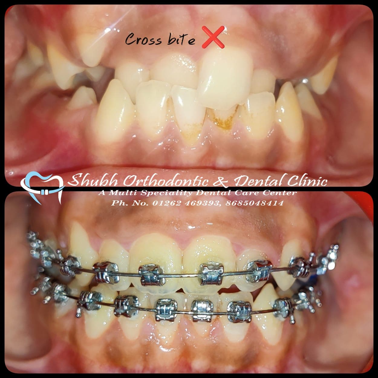 Orthodontic Case #8