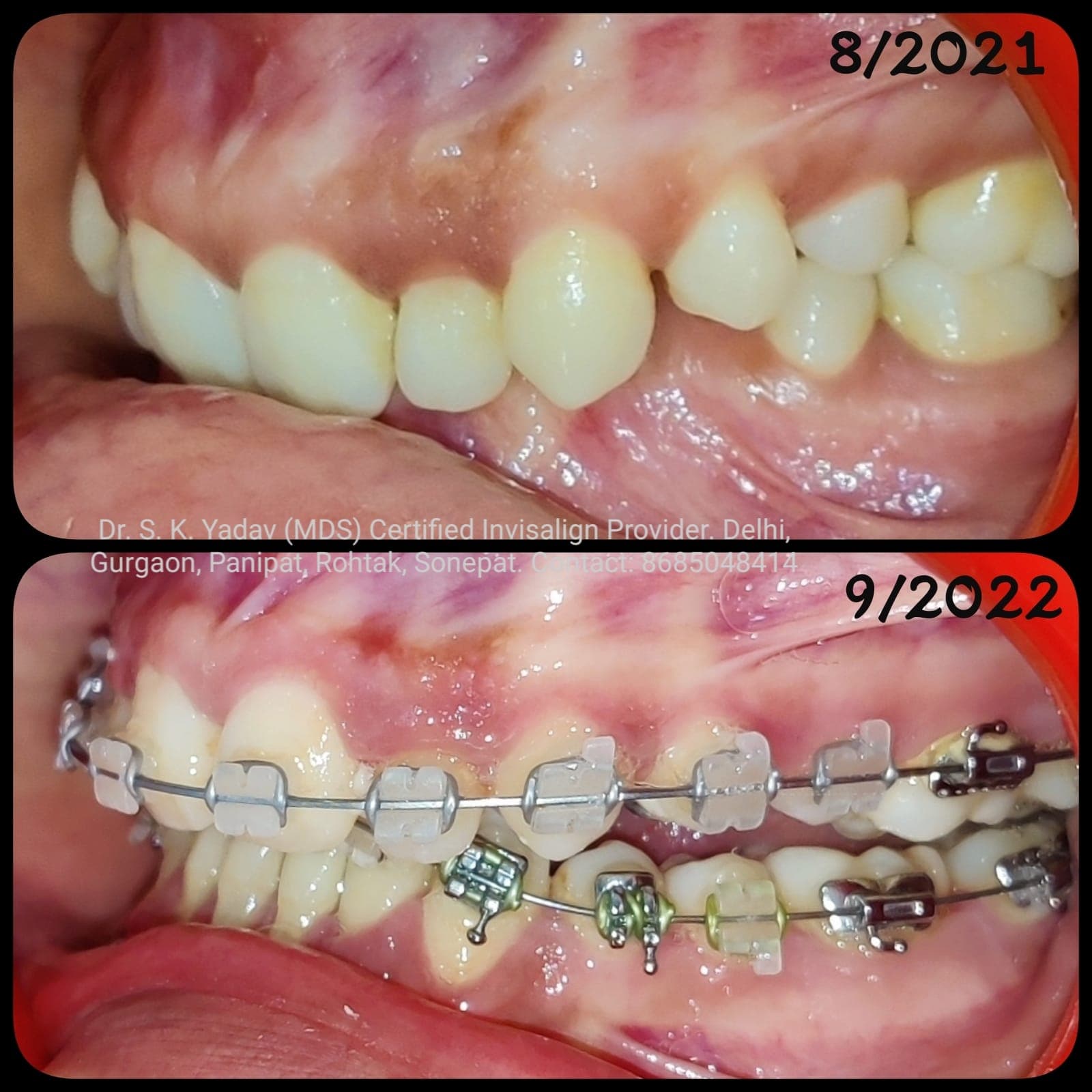 Orthodontic Case #11