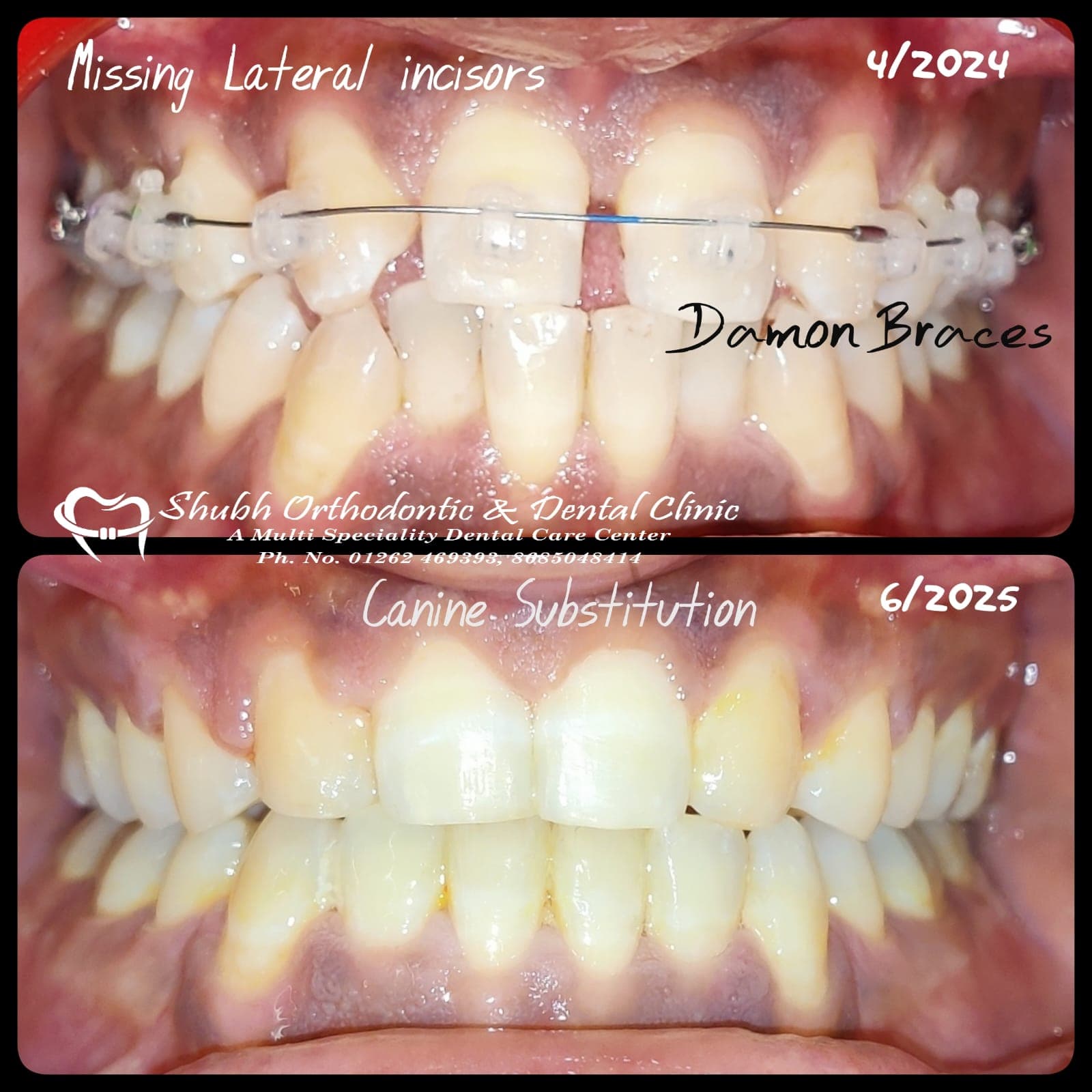 Orthodontic Case #12