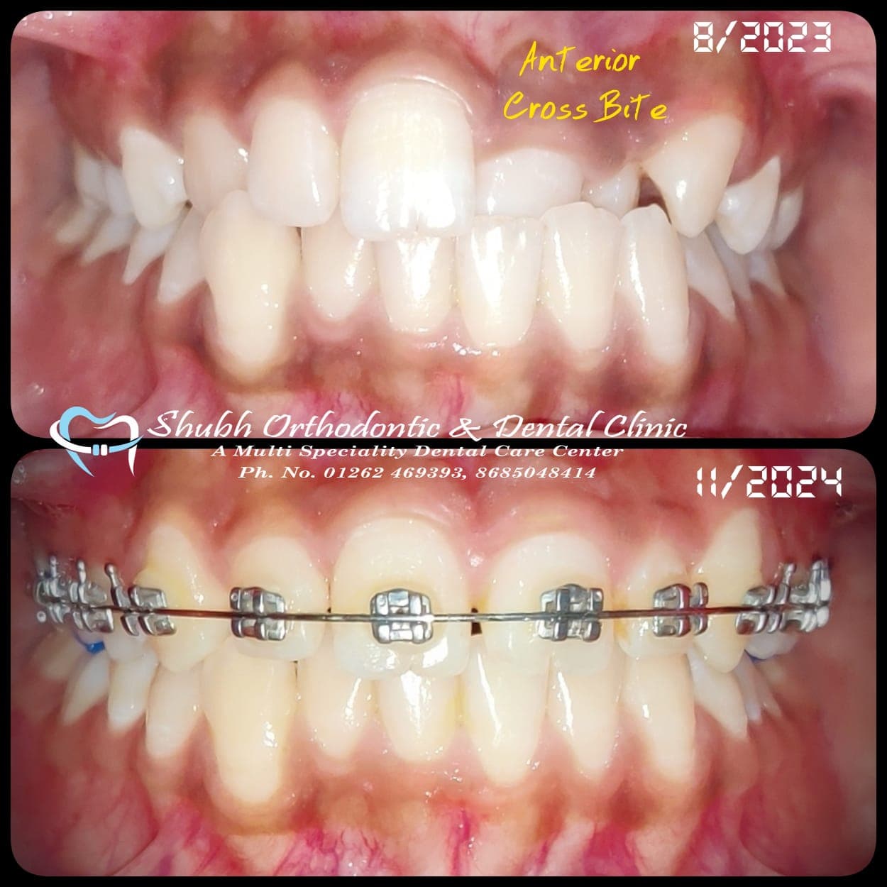 Orthodontic Case #14