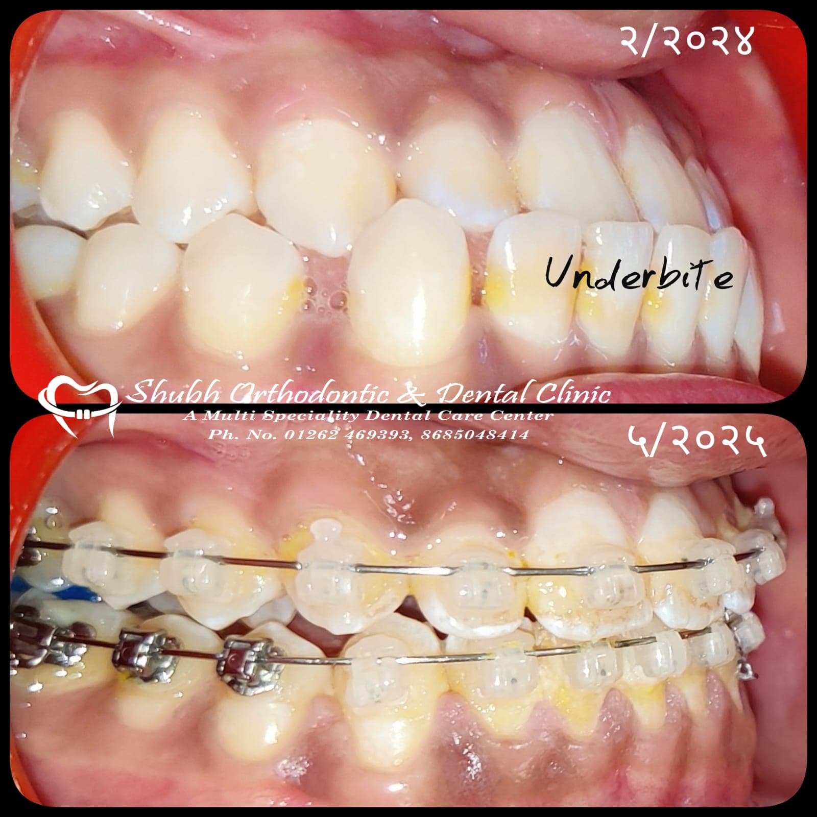 Orthodontic Case #16