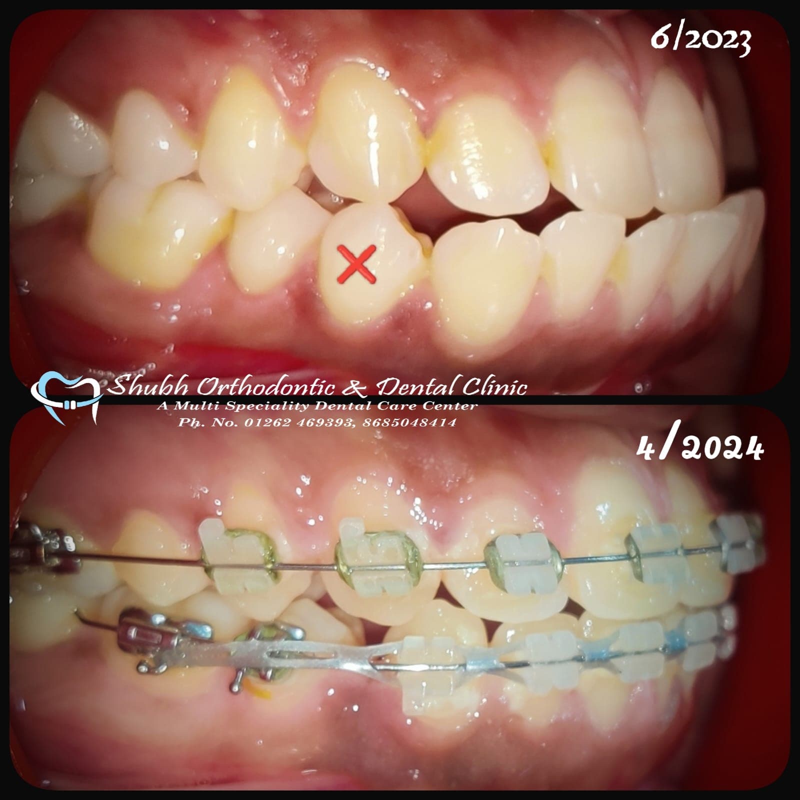 Orthodontic Case #18