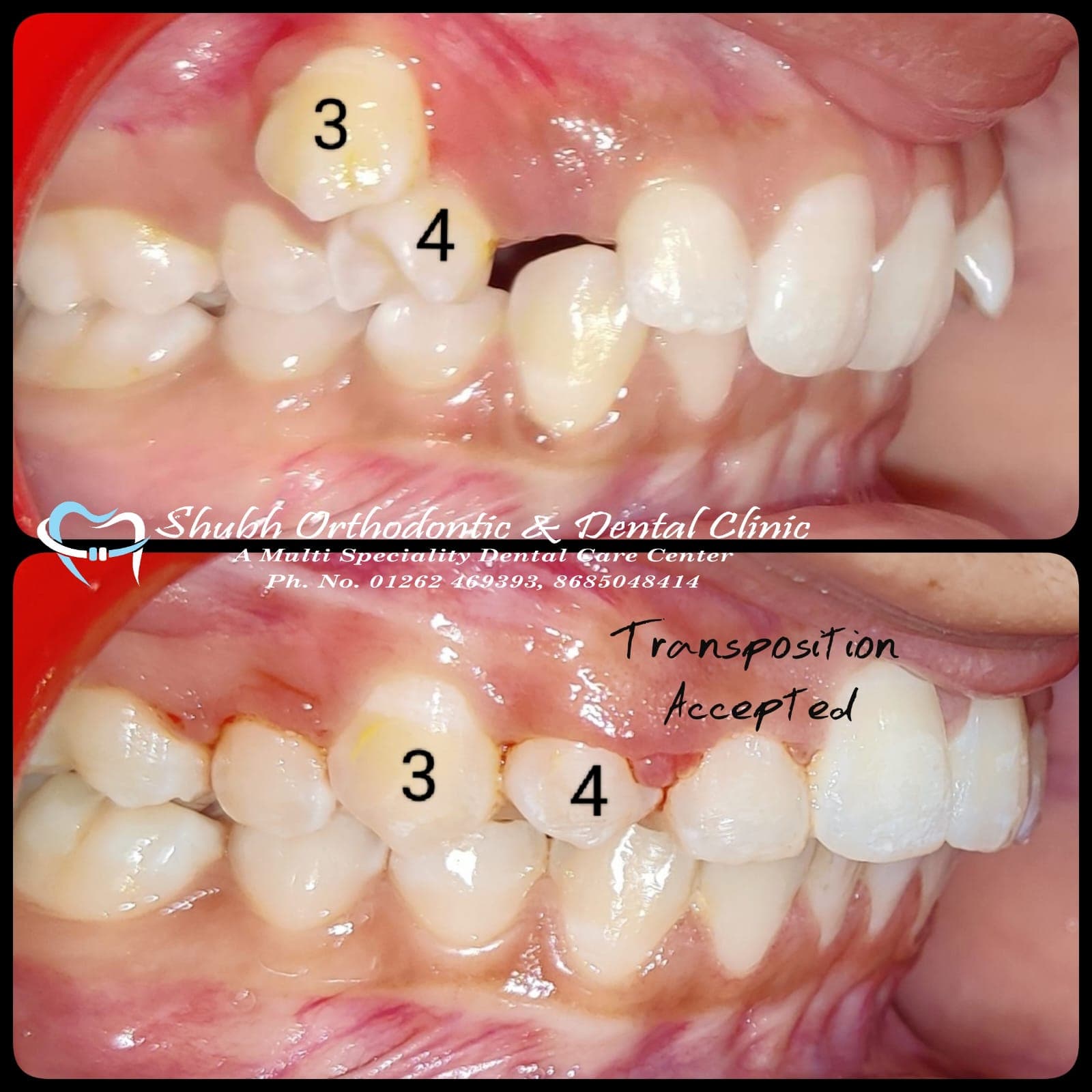Orthodontic Case #23