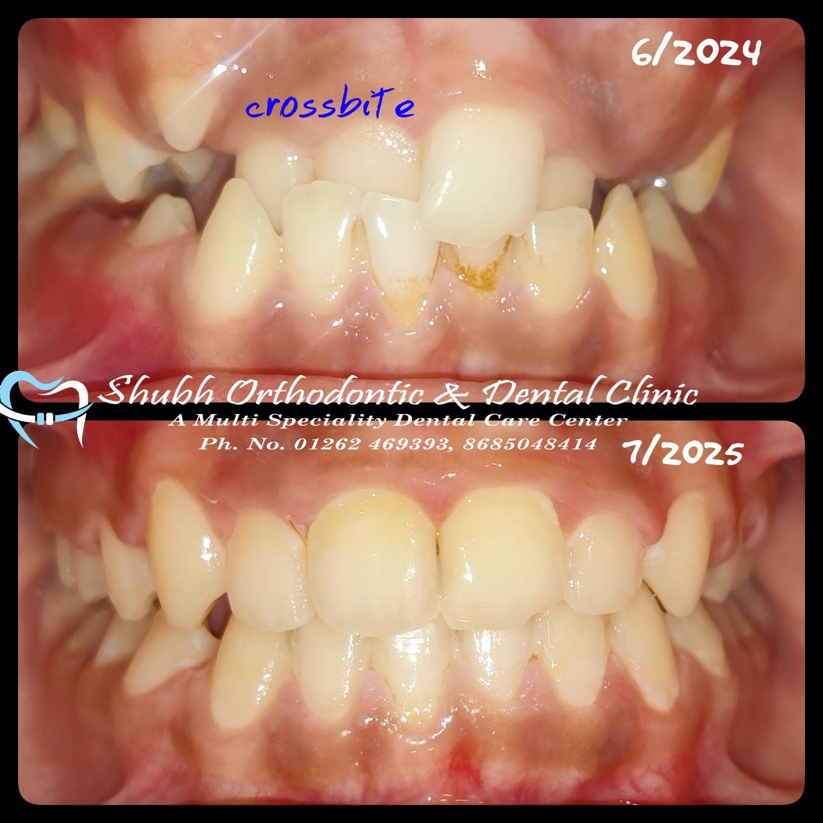 Orthodontic Case #35