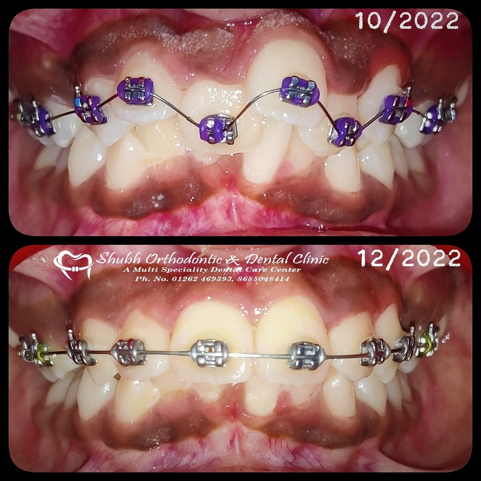 Orthodontic Case #36