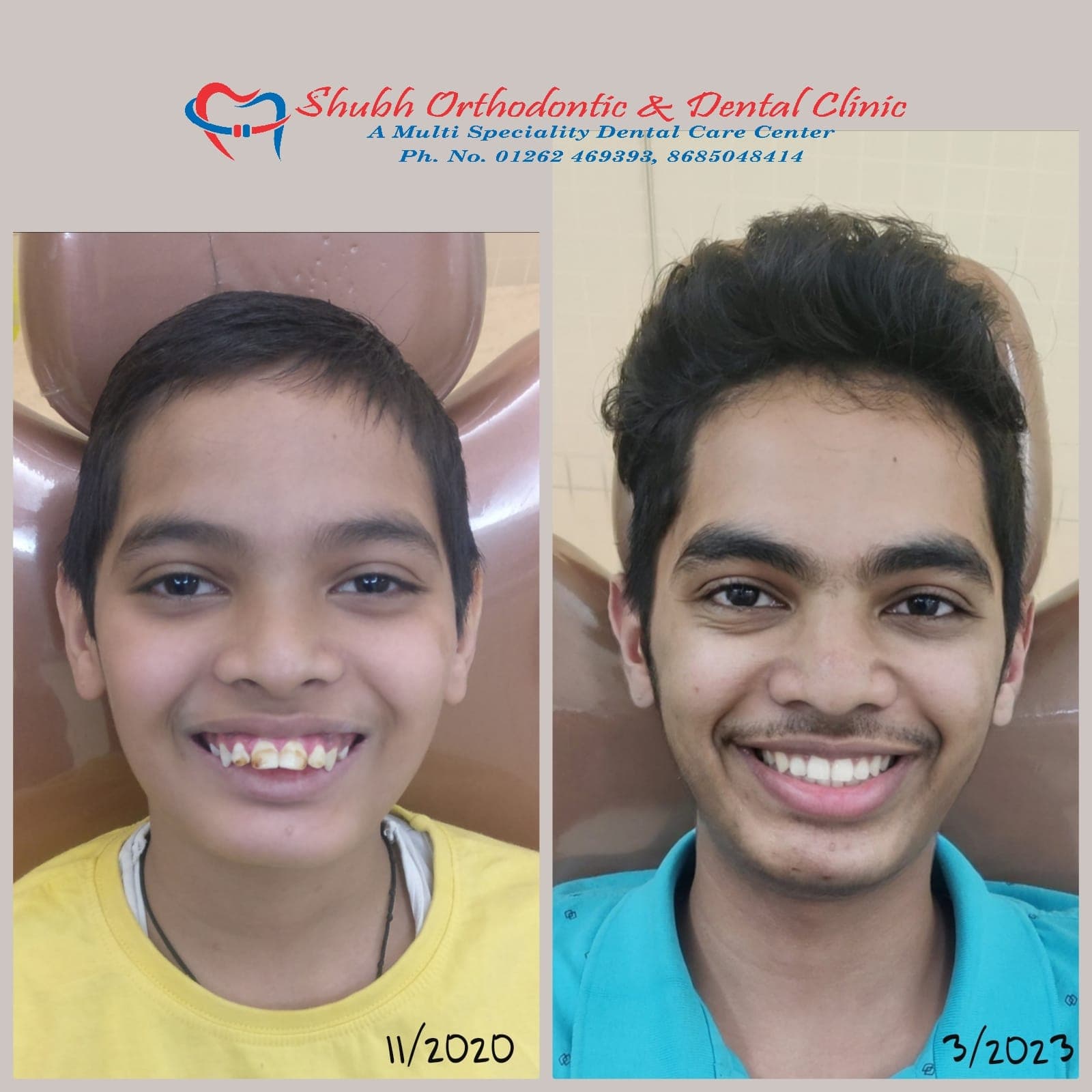 Smile Transformation #2