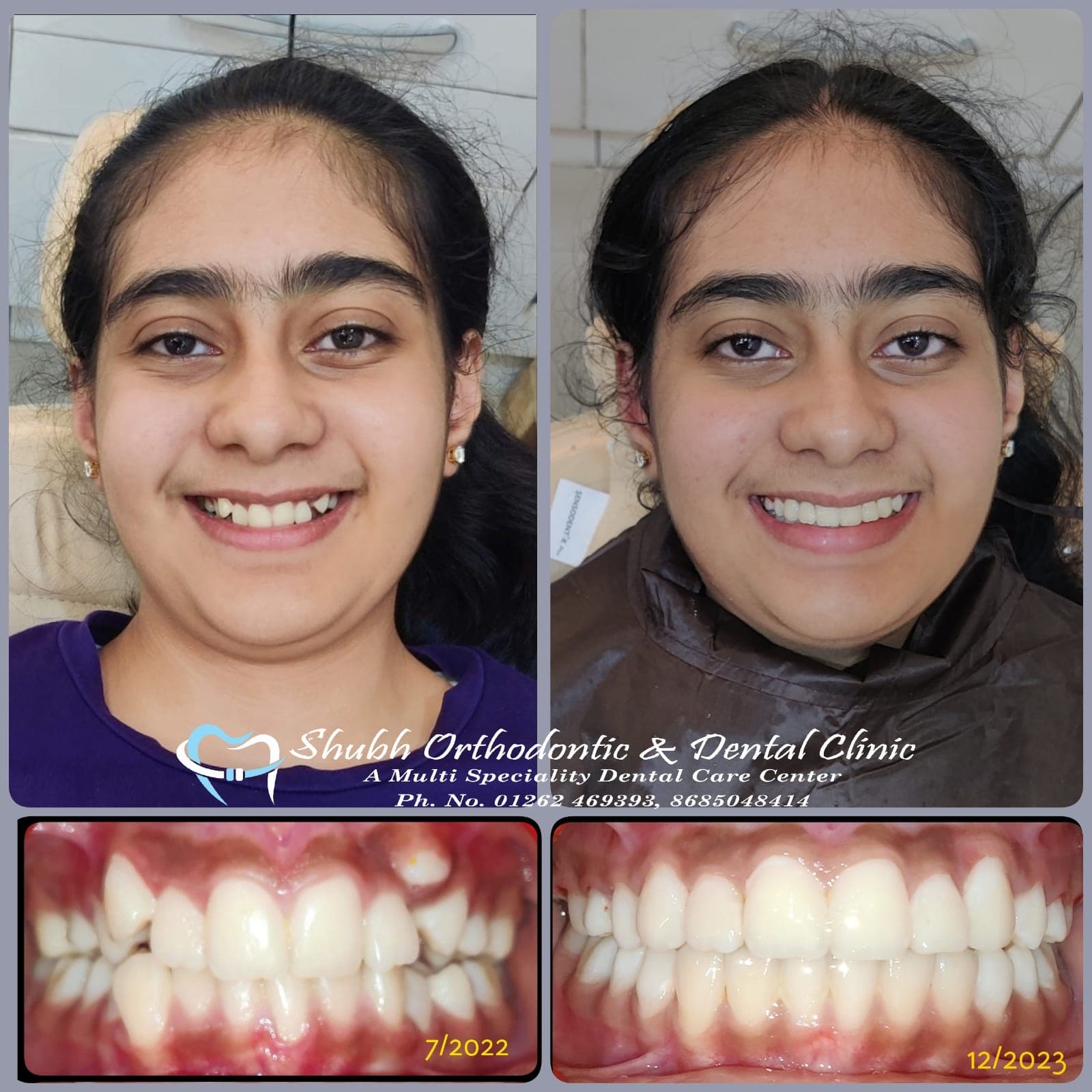 Smile Transformation #10