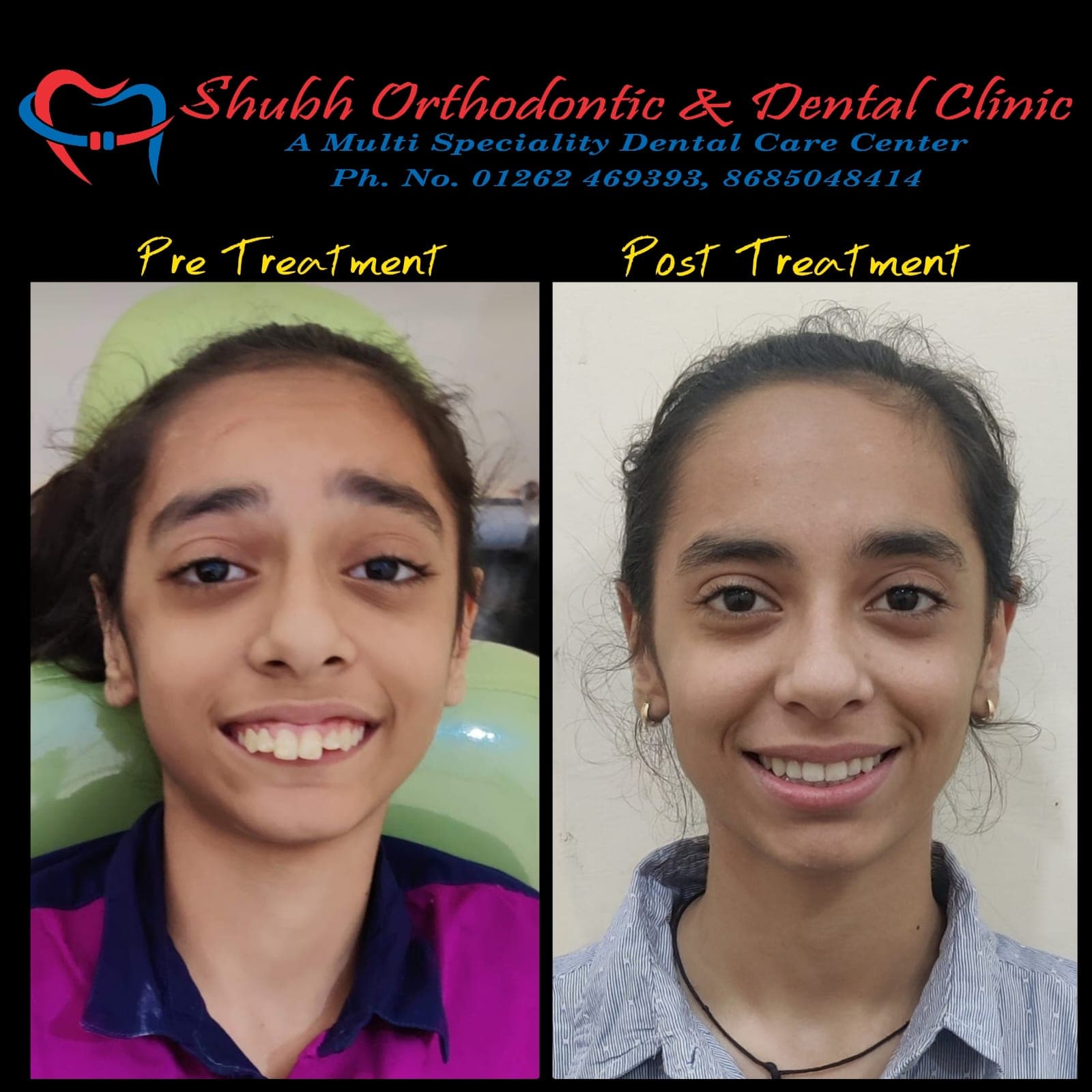 Smile Transformation #17