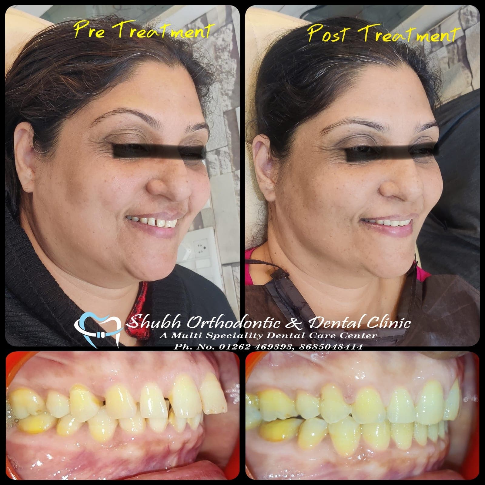 Smile Transformation #19