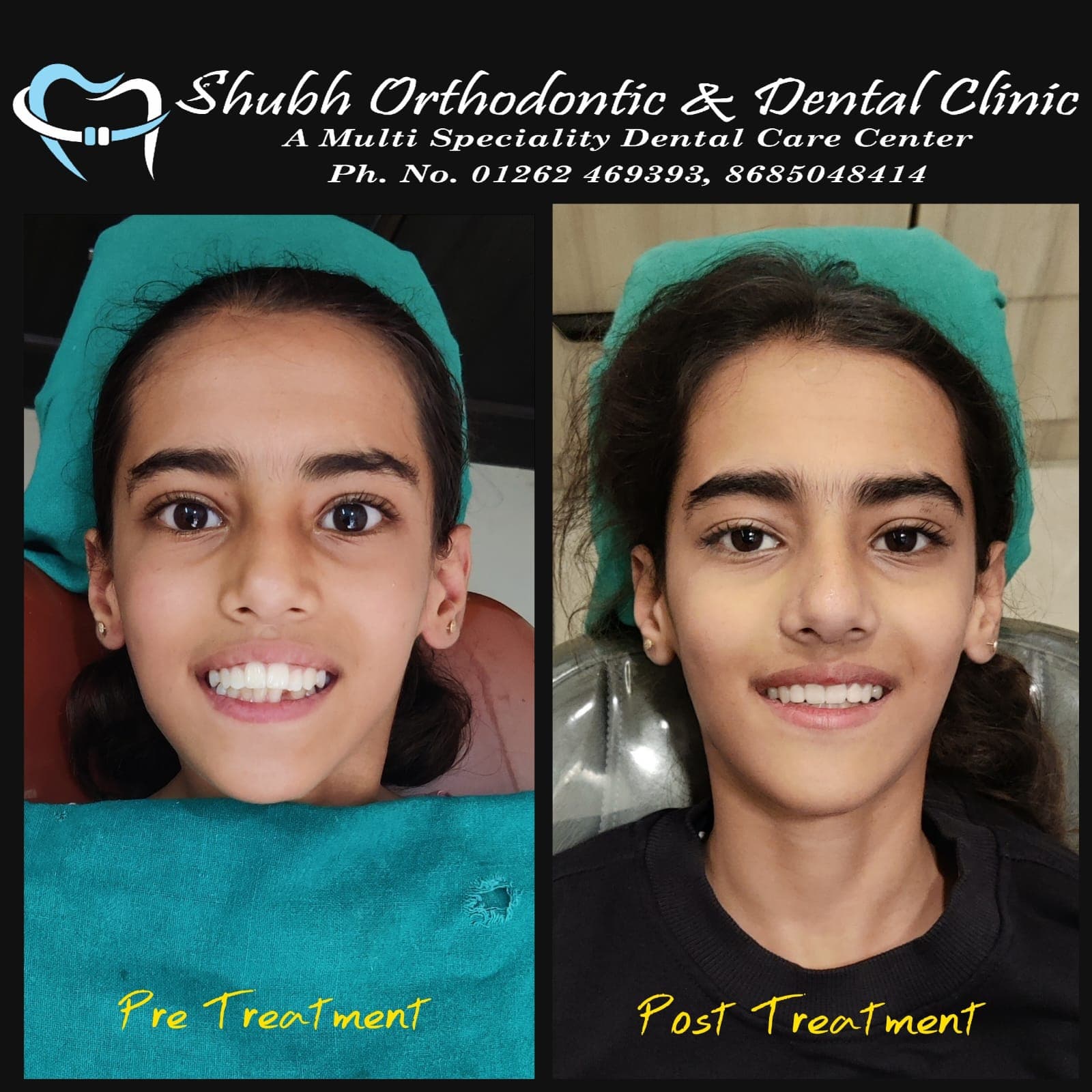 Smile Transformation #25