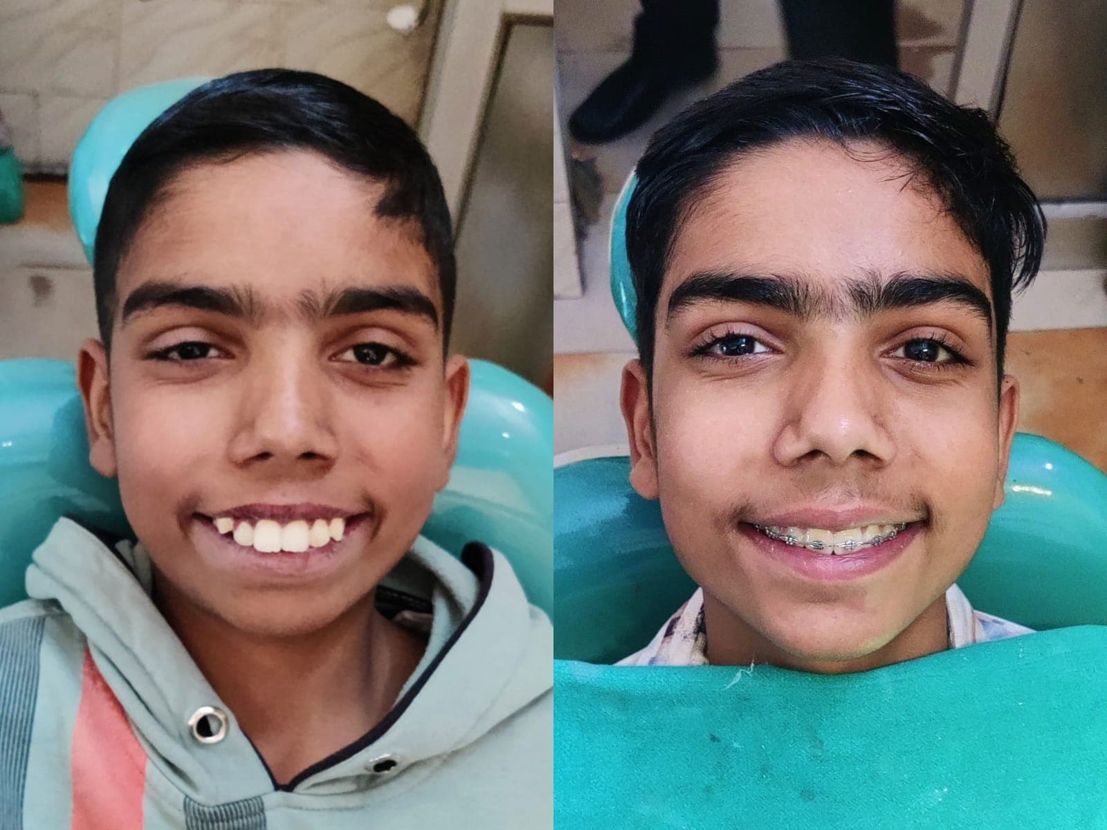 Smile Transformation #30