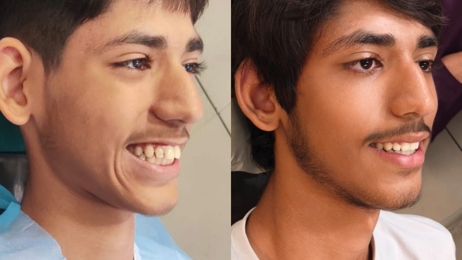Smile Transformation #32