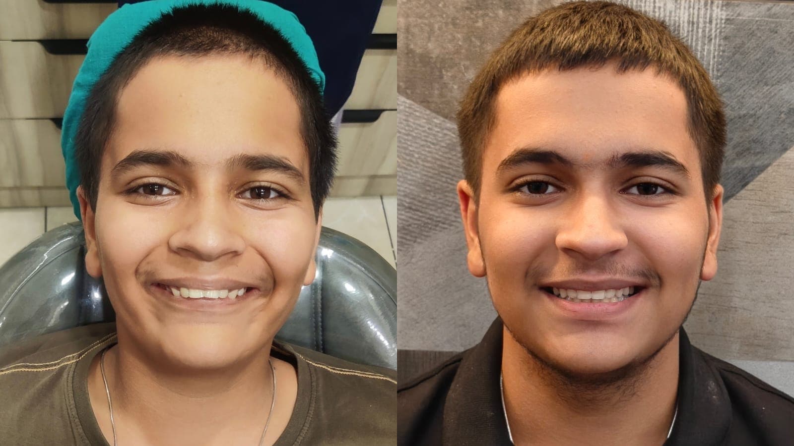 Smile Transformation #34